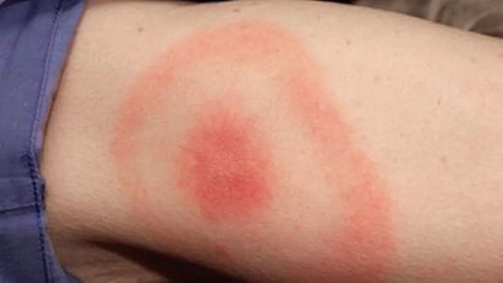 tick bite rash and Lyme disease
